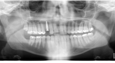 titanium-screw-dental-exray